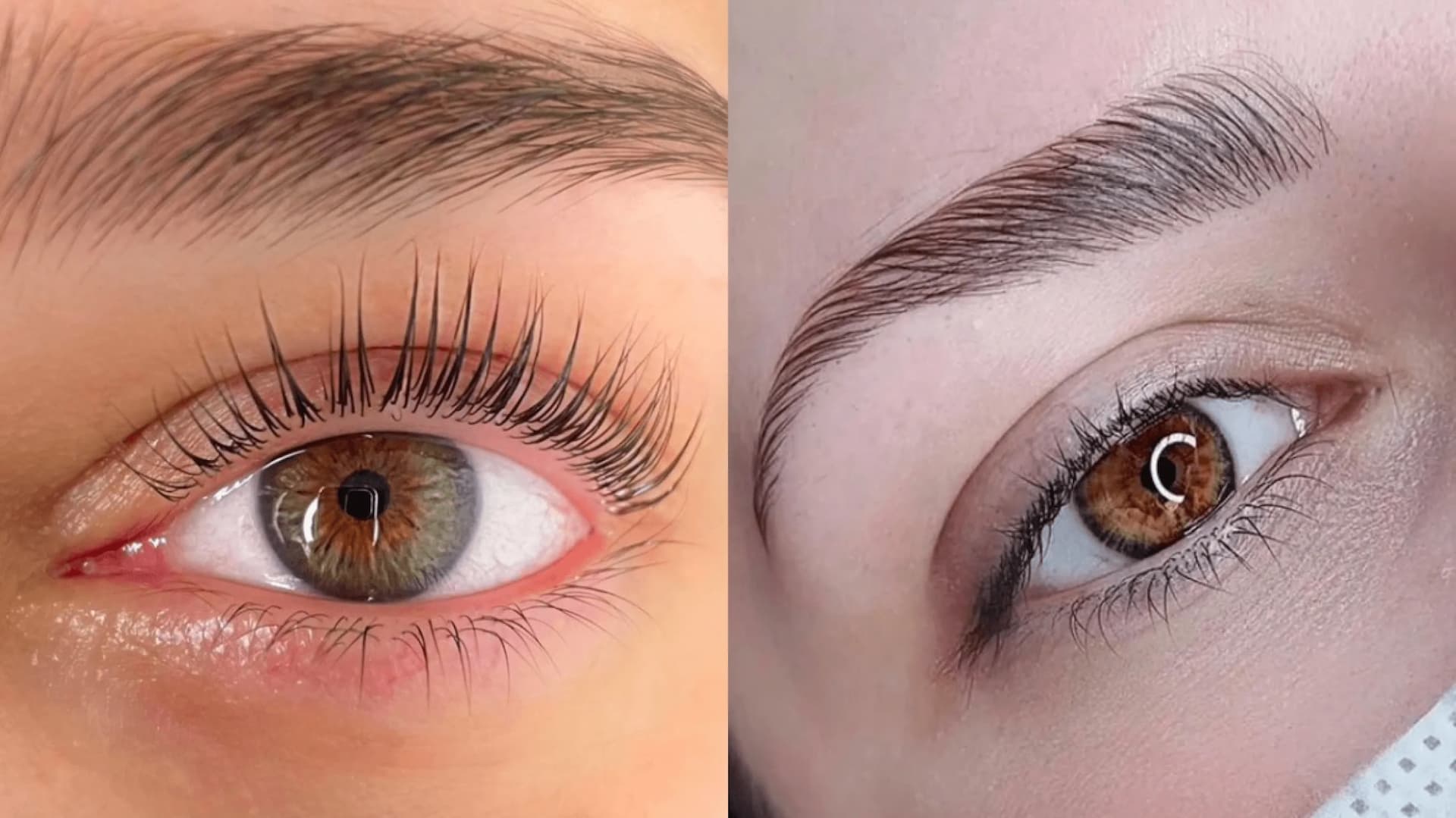 Augenbrauenlifting: Methoden, Vorher-Nachher & Kosten