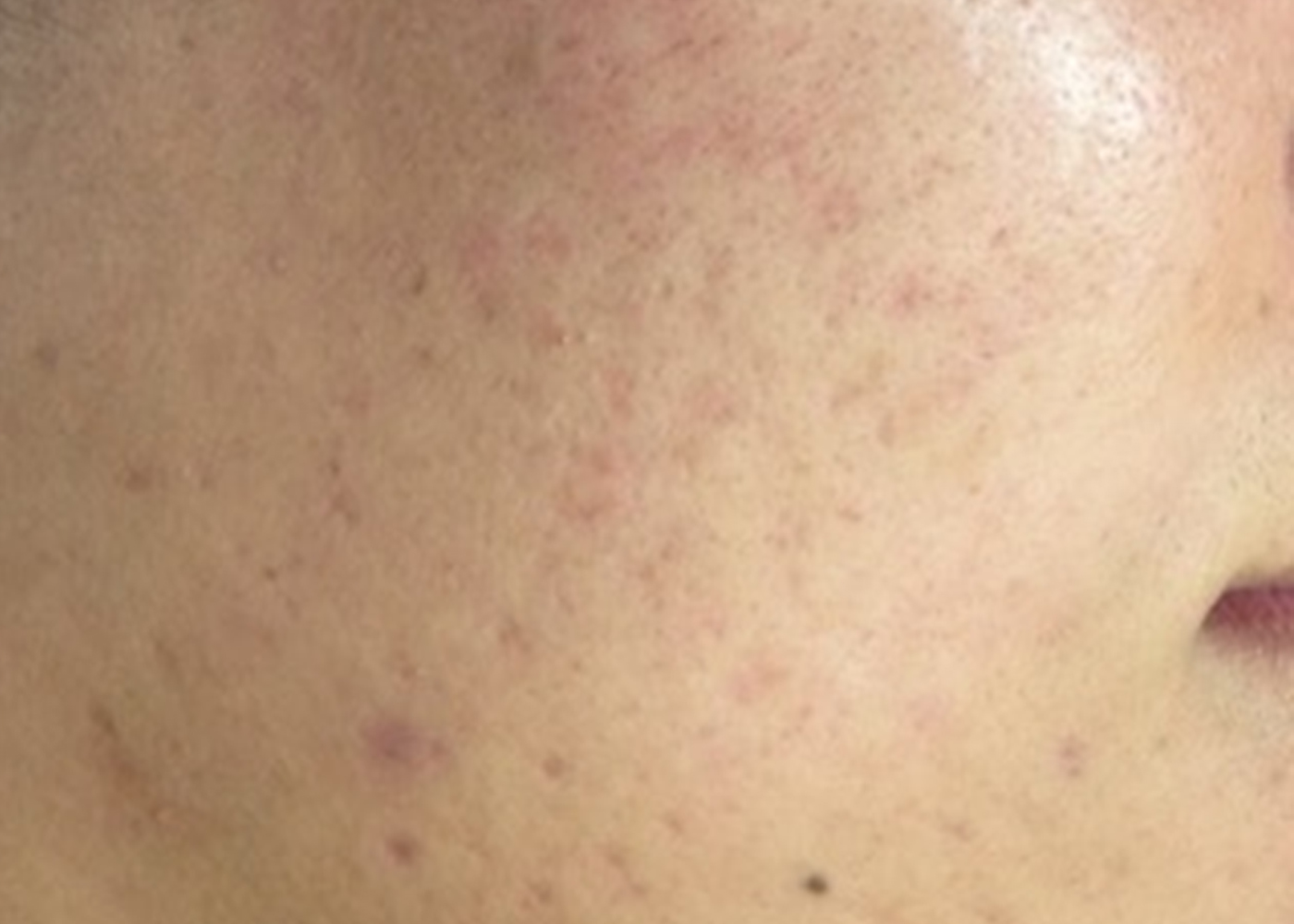 Soemantri Ästhetik Institut, Lüdenscheid, SkinPen, Medizinisches Microneedling, Gesichtsbehandlung, Premium, NRW