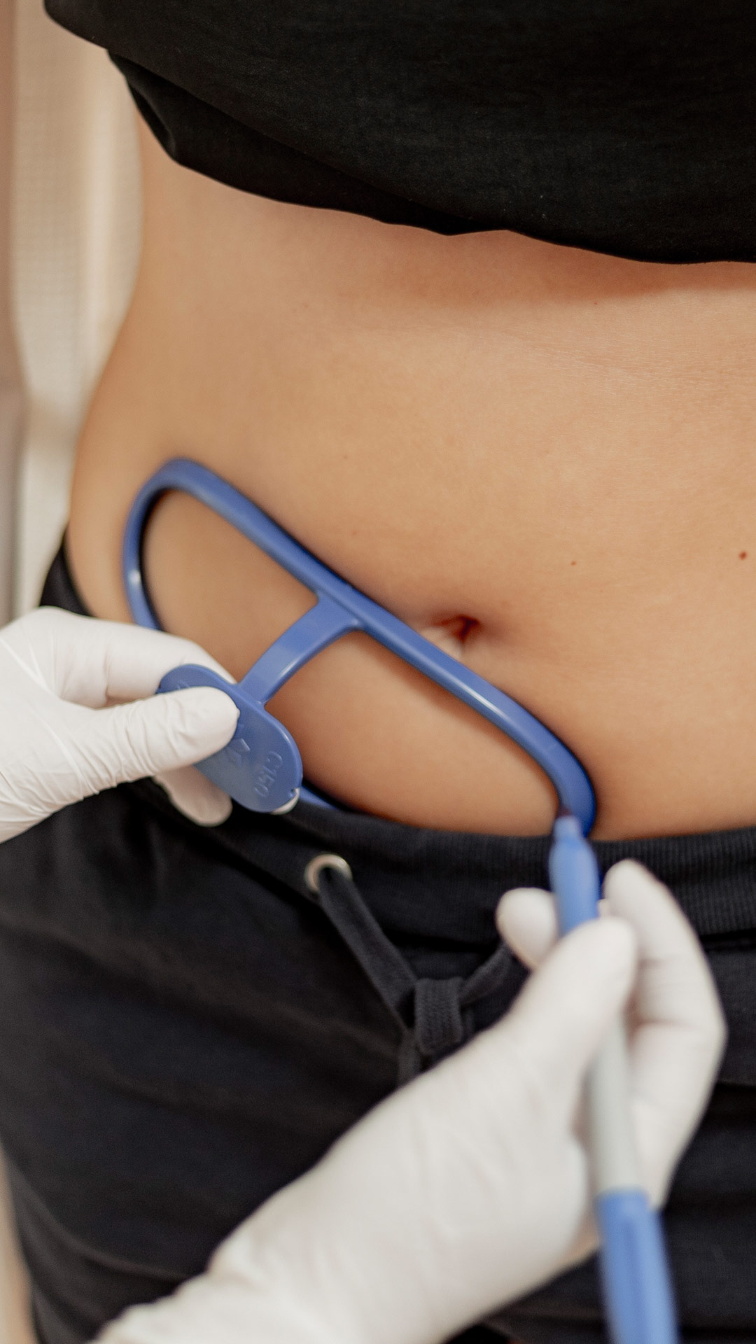 Soemantri Ästhetik Institut, Fettreduktion, Körperformung, CoolSculpting ELITE, Lüdenscheid, Schönheitsbehandlung, ohne OP